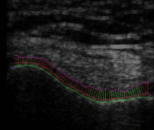 Ultrasound Imaging of Speckled Cartilage Tissue