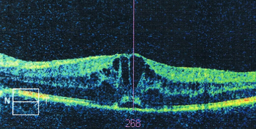 Automatic Detection of Macular Cysts | RSIP Vision