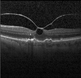 Denoising macular layers