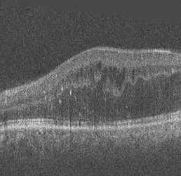 Curvelet speckle denoising