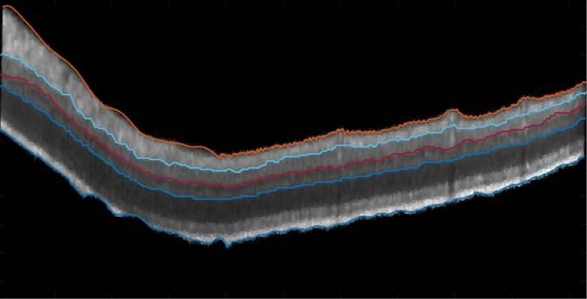 Layer segmentation of the retina