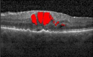 Cyst detection