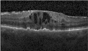 Manual annotation of cysts