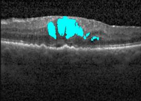 Detected Cysts