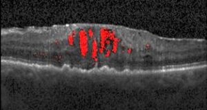 Detected Cysts Using CNN