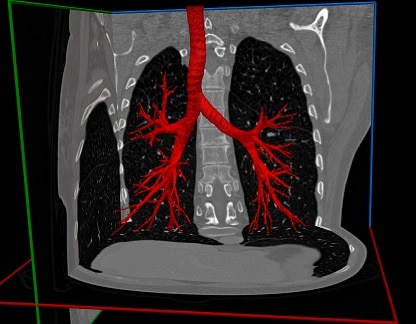 Airways Segmentation