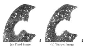 Chest CT registration