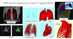 Chest Segmentation