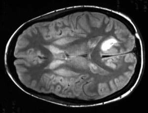 Brain Tumor Segmentation