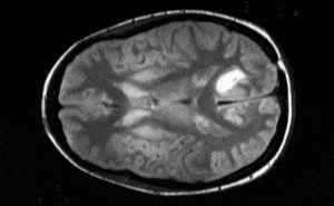 Brain tumor segmentation