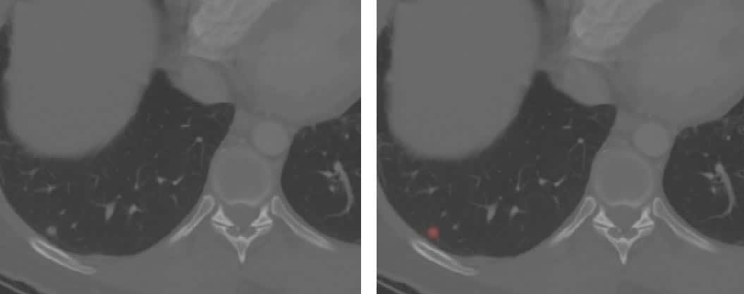 Lung nodule segmentation