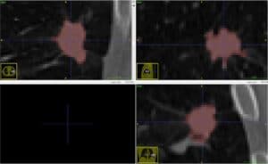 Lung tumor - zoom