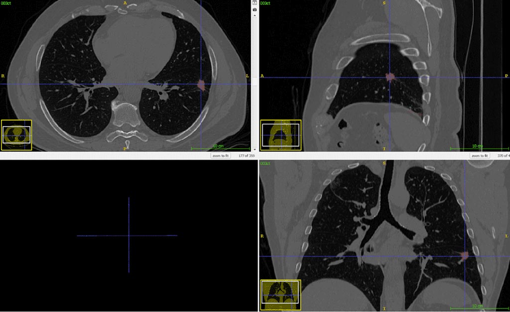 Lung tumor