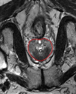 Prostate Segmentation