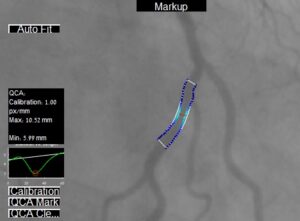 Quantitative Coronary Analysis