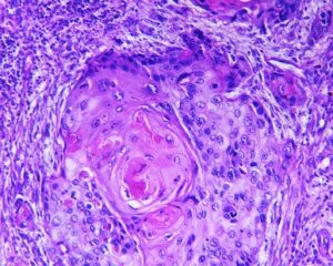 Squamous cell carcinoma