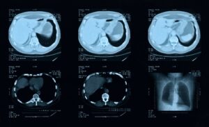 Cardiac MRI with Left Ventricle