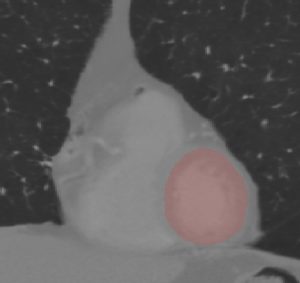 Left Ventricle Segmentation