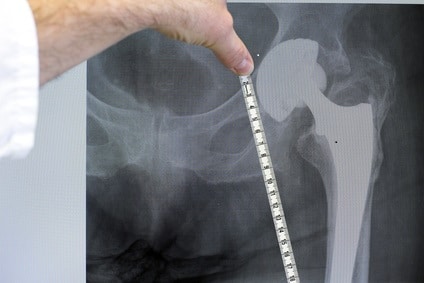 Hip replacement surgery measurements