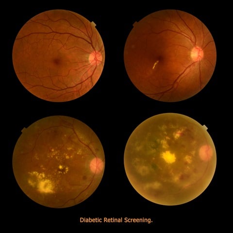 Diabetic Retinal Screening