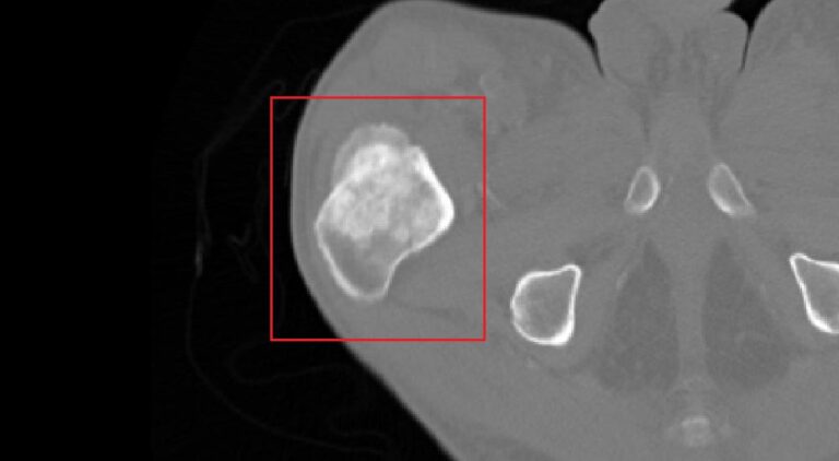 Osteosarcoma