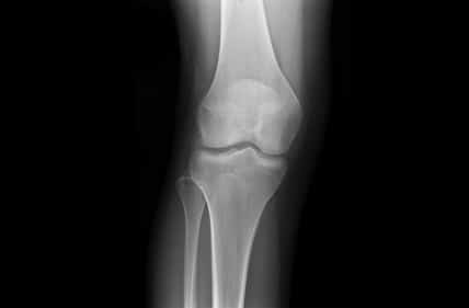 X-ray knee joints with overlapping bones