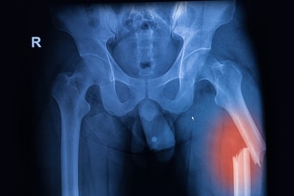 Left femur fracture