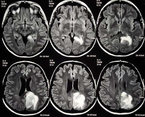 Axial cut of brain MRI