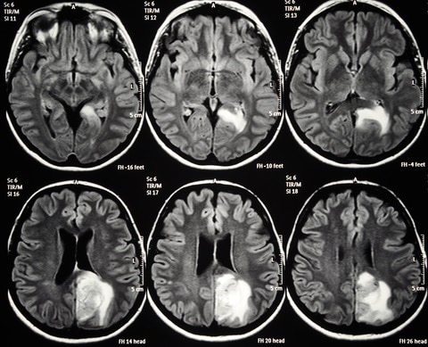 brain mri scan tumor