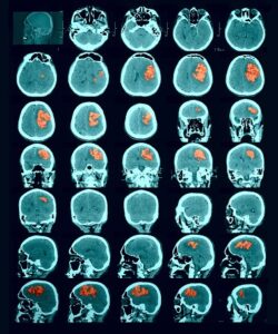 Lesion Detection in CT scan (Hemorrhagic stroke)