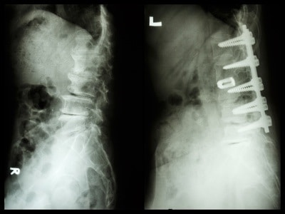 Spondylosis and its internal fixation
