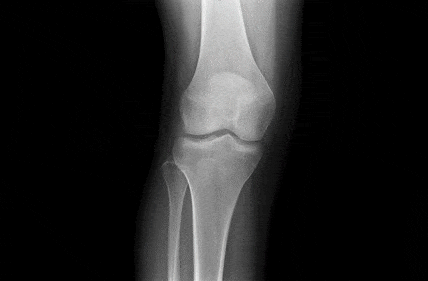 Knee orthopedics - sparse set of points