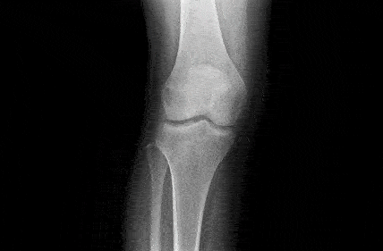 Knee orthopedics