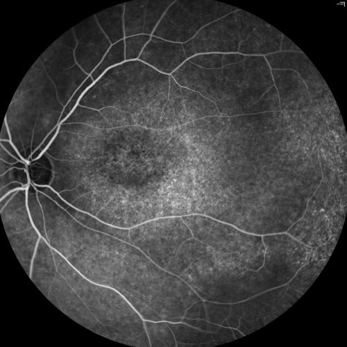 Fluorescein Angiogram