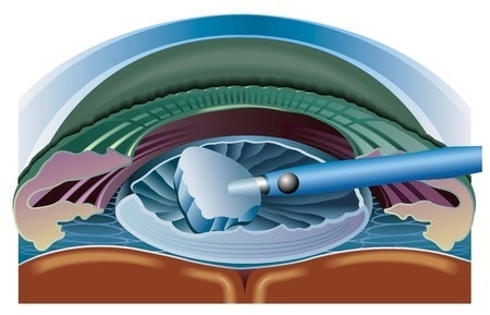 Cataract surgery