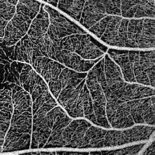 Optical coherence tomography angiography