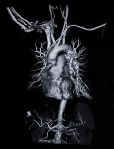 Coronary CT Angiography