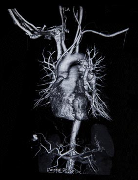 Coronary CT Angiography