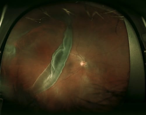 Giant Retinal Tear