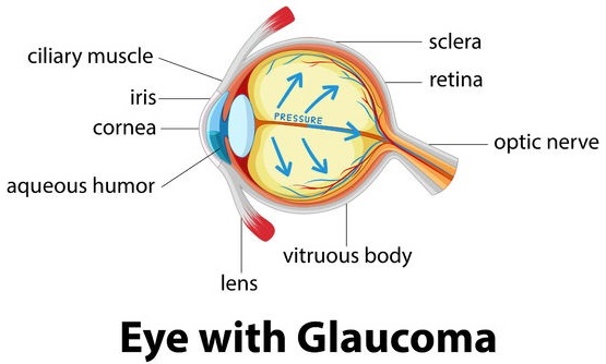 Eye with Glaucoma