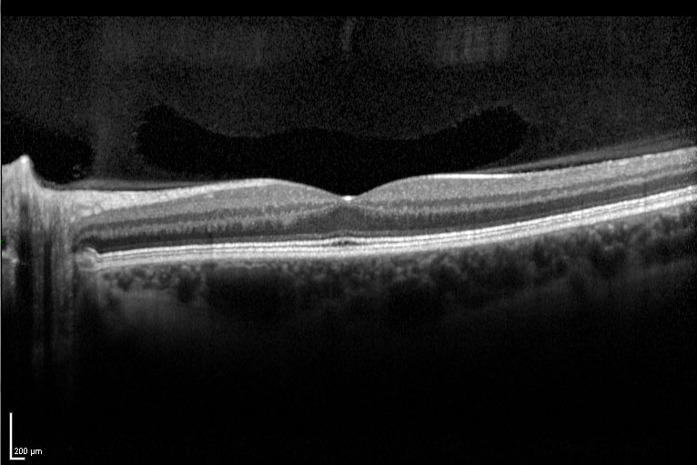 retinal layers oct