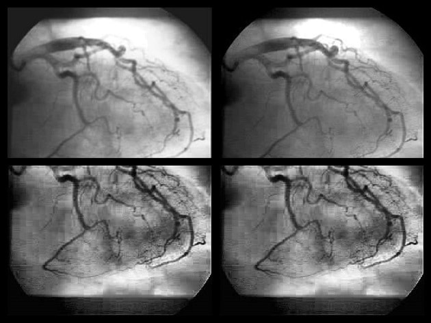 3D Reconstruction of the heart