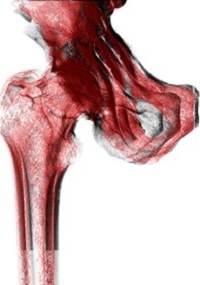 2D C-Arm X-ray scan is registered to 3D CT scan