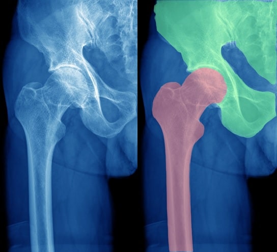 Orthopedic Surgery - CT Segmentation