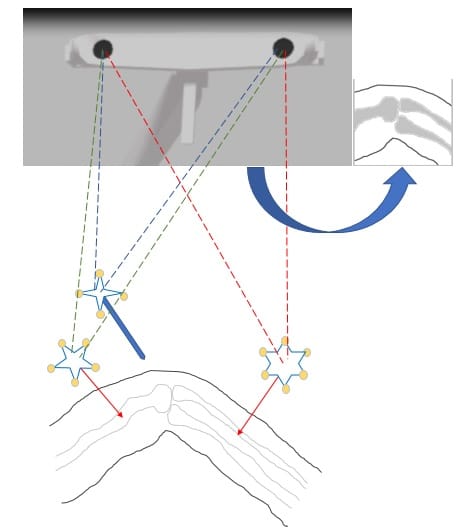 Markers in Orthopedic navigation system