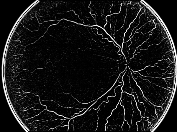 ROP - Vessel tortuosity in Retinopathy of Prematurity