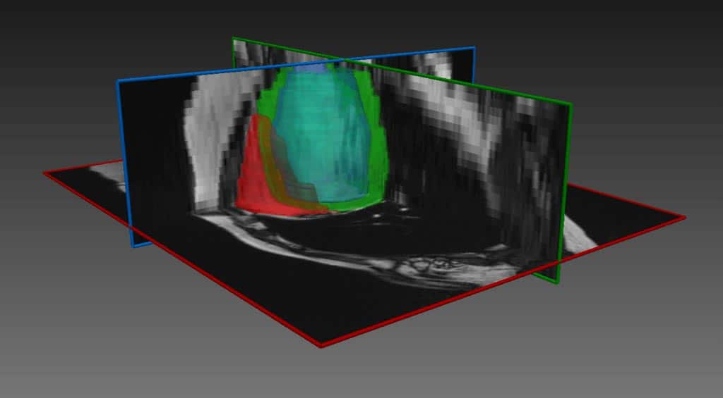 3D cardiac MRI with DL