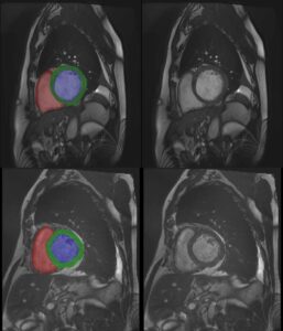 Cardiac MRI 3D automatic segmentation