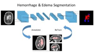 Hemorrhage and Edema segmentation with Deep Learning