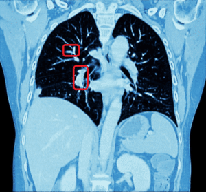 Visible lung cancer on CT scan of chest and abdomen